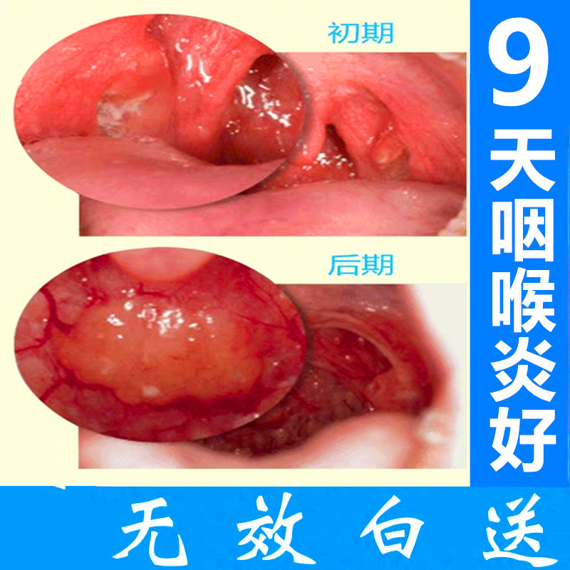 喉咙发炎干痒咽喉肿痛异物感成人喉咙喷剂扁桃体发炎儿童喷雾剂