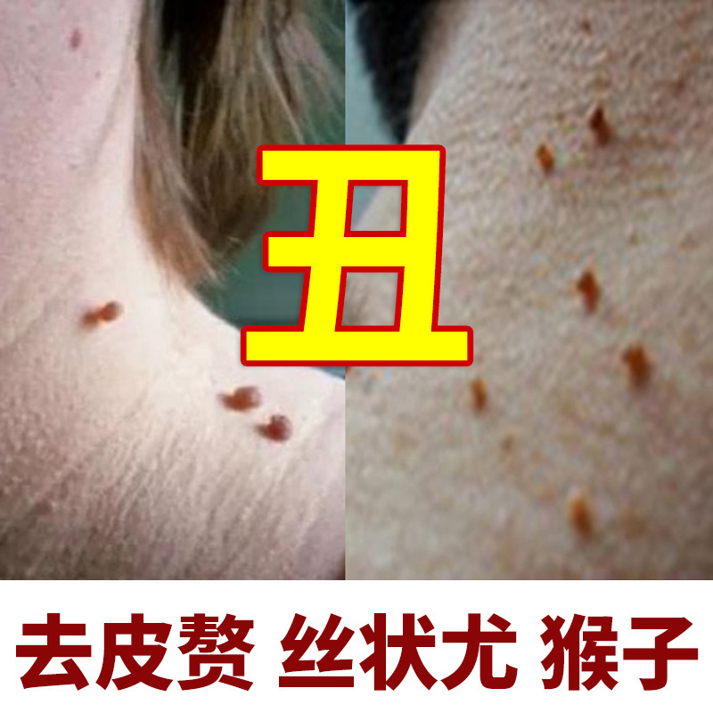 皮赘去除膏无痛去小肉粒疙瘩颈部脖子腋下肉赘瘊猴子丝状扁平尤膏