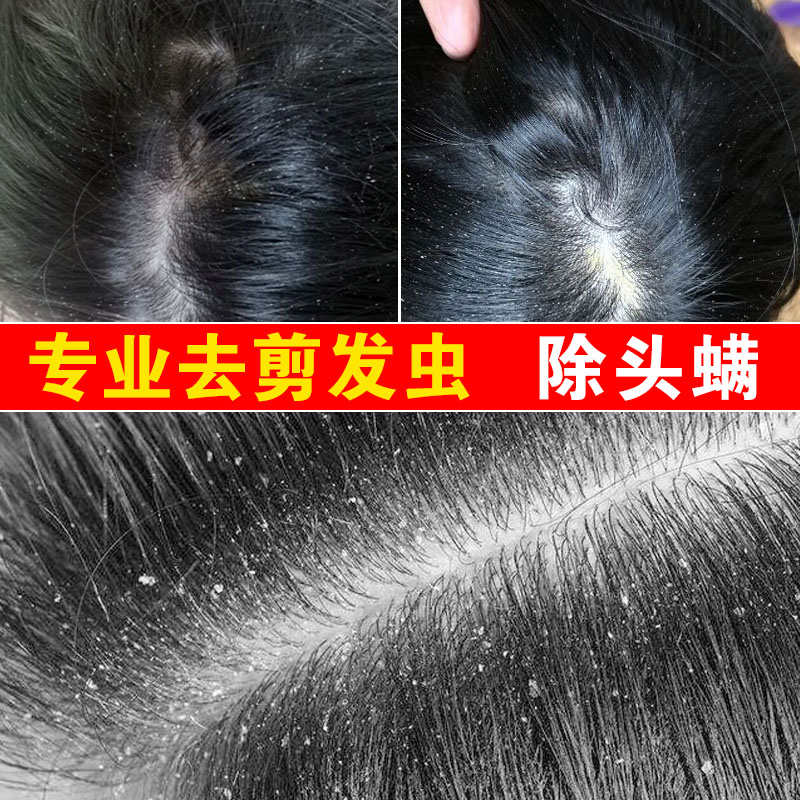 去卷发虫专业除吃发虫儿童缠发断发抗真菌除螨虫剪发虫洗发水