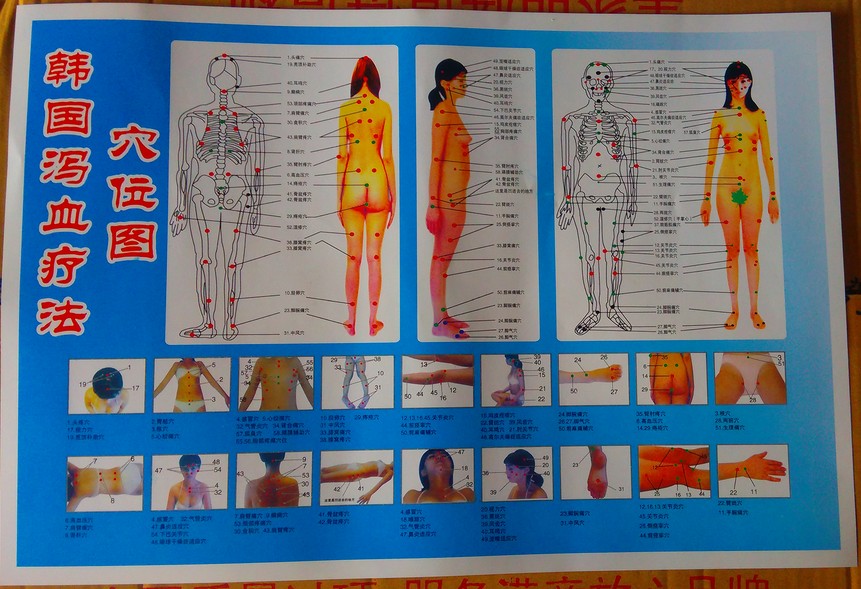 韩国泻血疗法穴位图 58泻血点位置图背面正面泄血图