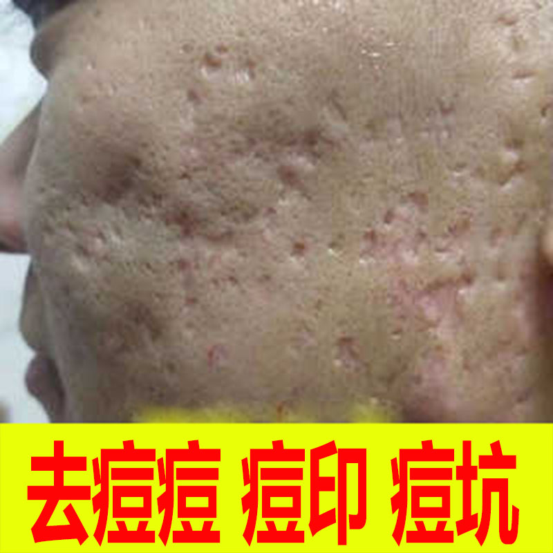 痘坑凹洞填充再生女祛痘印痘坑痘疤修复男士脸上的坑毛孔粗大脸部